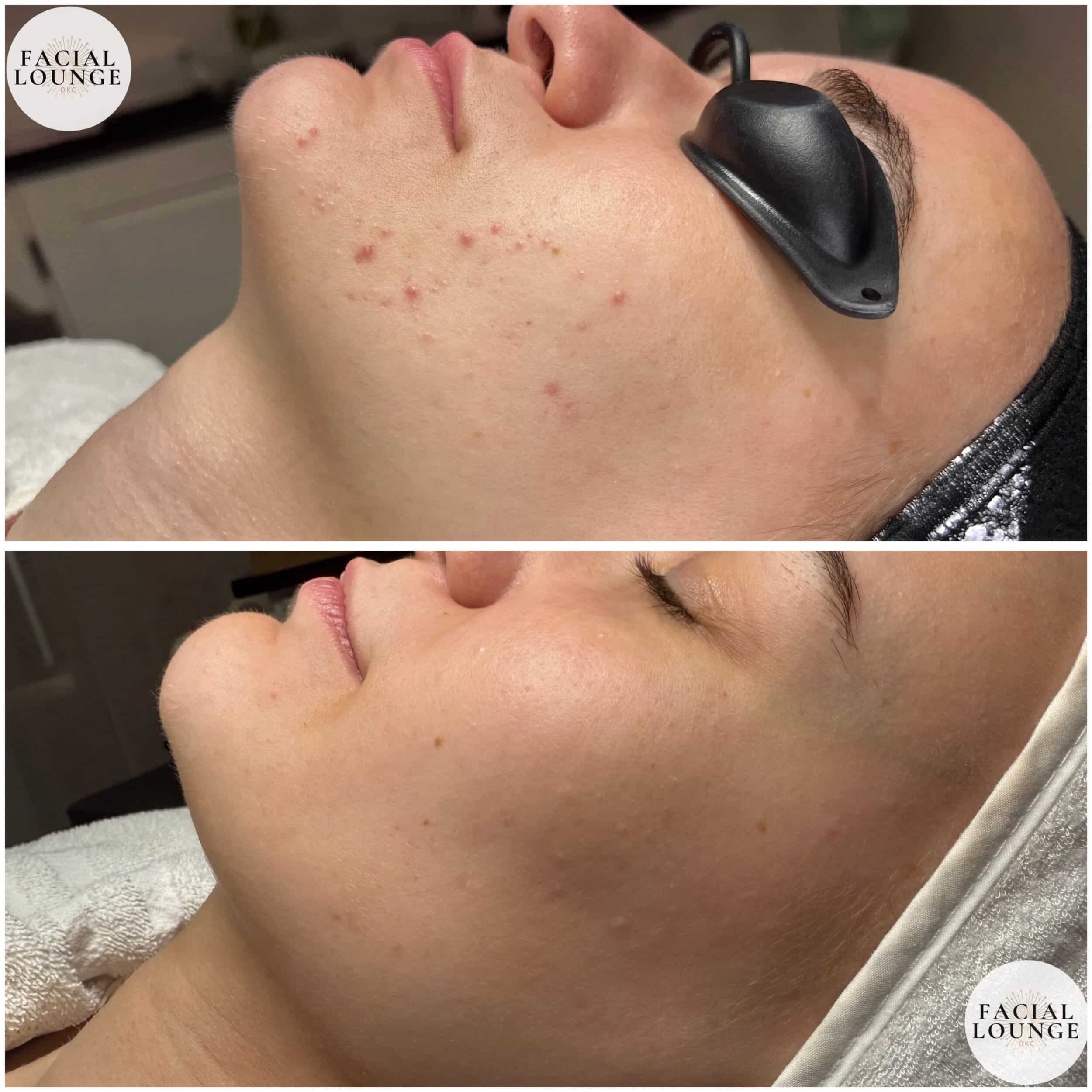 Key Ingredients to Treat Acne: Benzoyl Peroxide: A powerful antibacterial ingredient that kills acne-causing bacteria deep within the pores. It also reduces inflammation and prevents new breakouts from forming. Mandelic Acid: A gentle yet effective alpha hydroxy acid (AHA) that exfoliates the skin, promotes cell turnover, and helps fade hyperpigmentation. Mandelic acid is particularly effective for treating inflamed acne and post-inflammatory dark spots.
