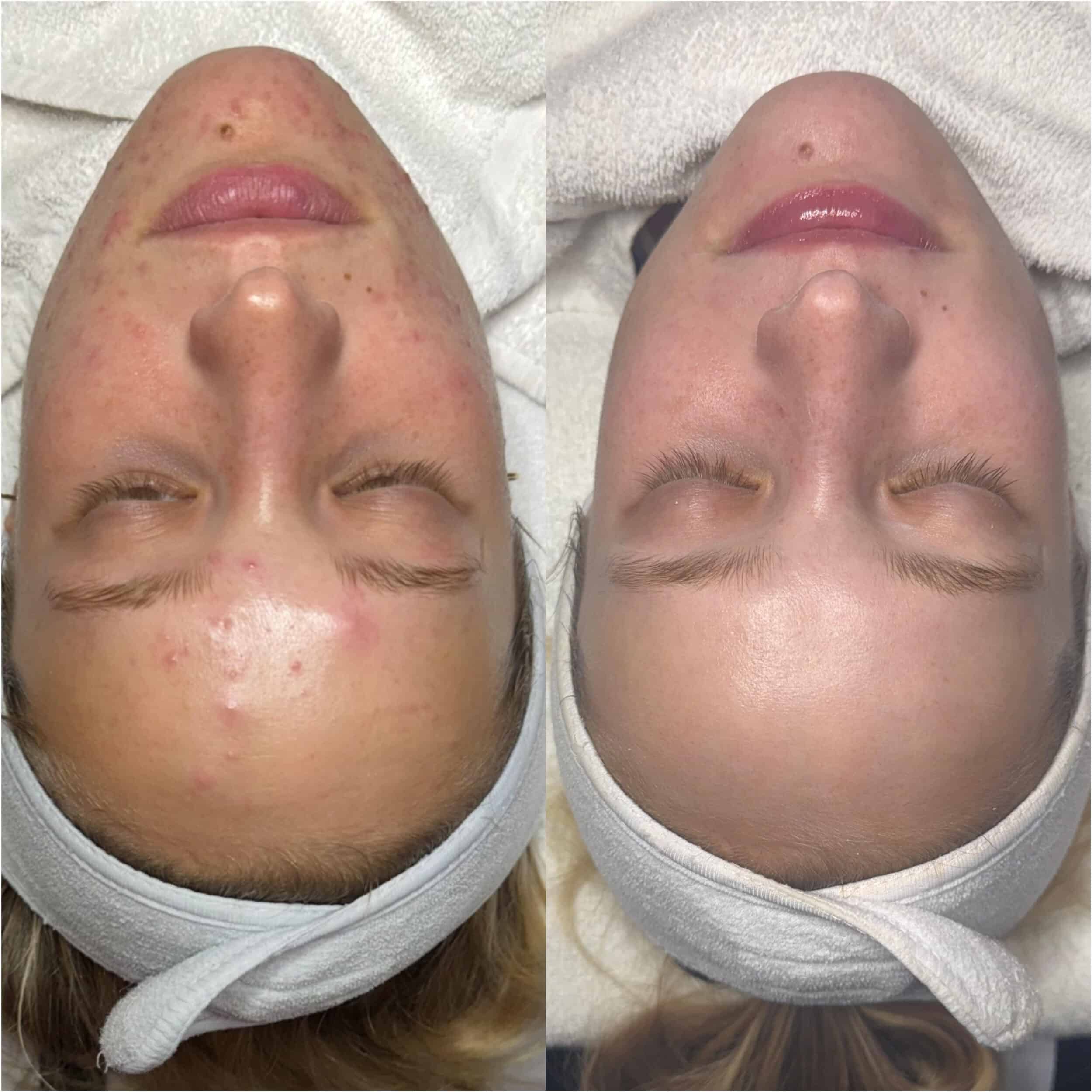 Key Ingredients to Treat Acne: Benzoyl Peroxide: A powerful antibacterial ingredient that kills acne-causing bacteria deep within the pores. It also reduces inflammation and prevents new breakouts from forming. Mandelic Acid: A gentle yet effective alpha hydroxy acid (AHA) that exfoliates the skin, promotes cell turnover, and helps fade hyperpigmentation. Mandelic acid is particularly effective for treating inflamed acne and post-inflammatory dark spots.